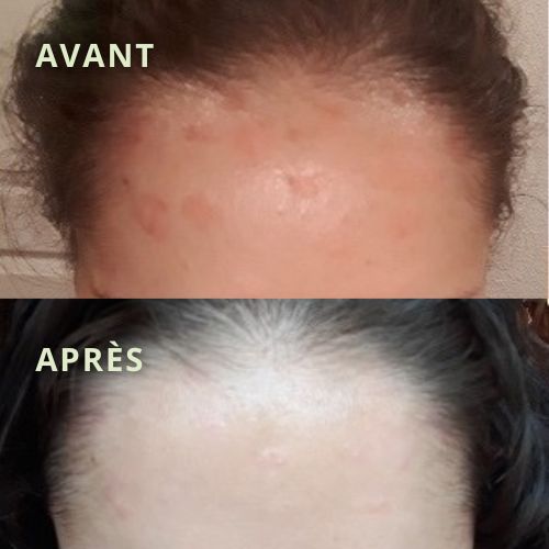 psoriasis-cuir-chevelu-avant-apres