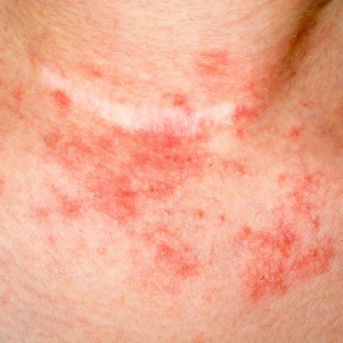 a quoi ressemble l'eczéma et ses symptômes