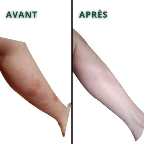 avant apres jambe soin pso natura temoignange client