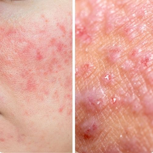 comment distinguer l'acné rosacée et la dermatite