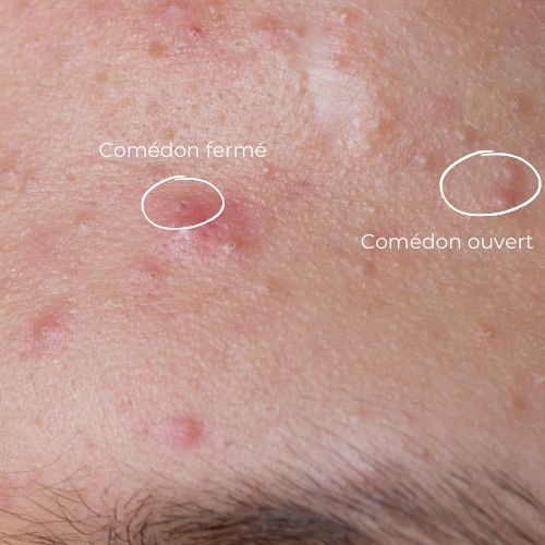 comédons ouverts et fermés en cas d'acné rétentionnelle