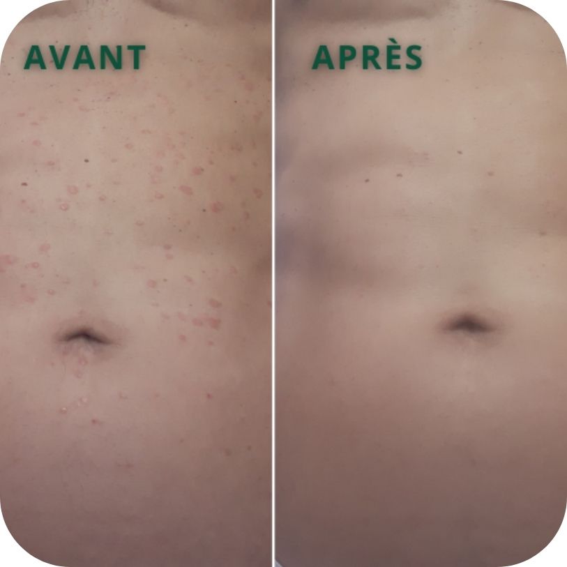 avant-apres resultat soins psoriasis pso natura ventre