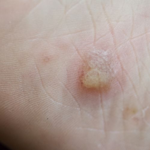 Eczéma dyshidrosique en photo