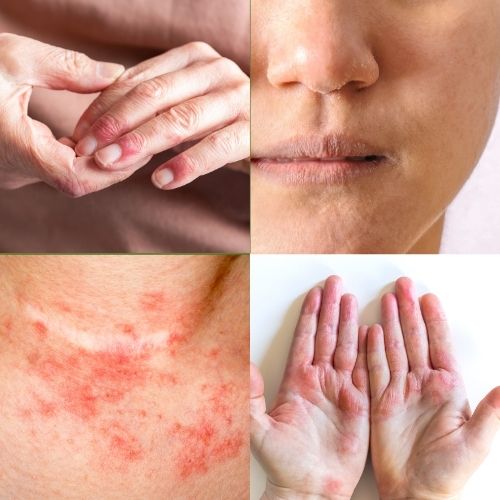 eczéma allergie photos mains, cou, visage