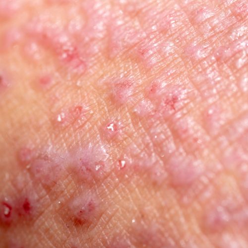 eczéma atopique en photo description