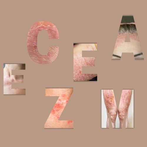 Eczéma en photos : identifier les symptômes et choisir le bon traitement