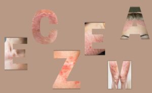 Eczéma en images : reconnaître les symptômes pour mieux traiter la peau
