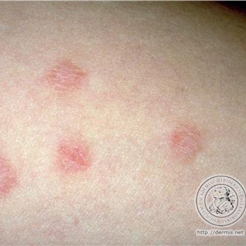eczema nummulaire photo