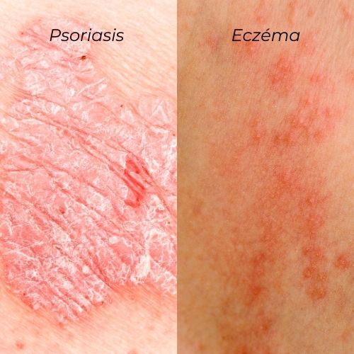eczema versus psoriasis comparaison