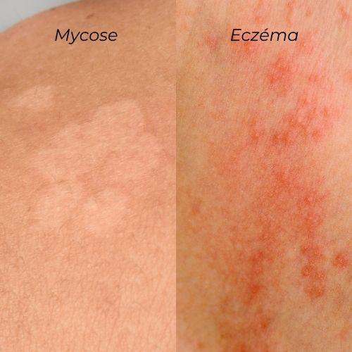 mycose versus eczéma comparaison