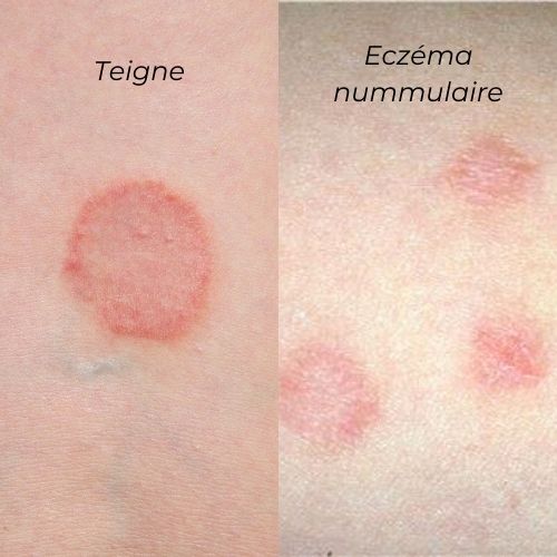 teigne versus eczema nummulaire