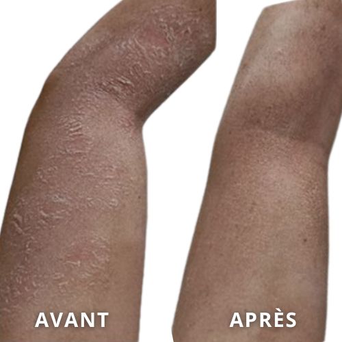 avant-après client bras psoriasis amélioration grâce au Complexe Régénérateur et Crème Riche Restructurante