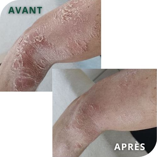 avant-après bras psoriasis amélioration grâce au Complexe Régénérateur et Crème Pso Natura