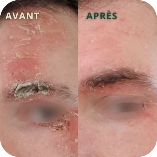 avant-après client psoriasis visage amelioration grâce au Complexe Régénérateur et la Crème riche restructurante