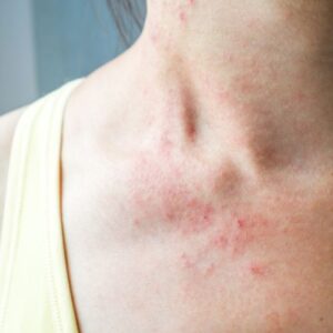 eczéma causes symptômes stars