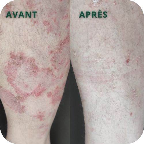 photo d'une jambe avec psoriasis avant et après traitement avec le Complexe Régénrateur Pso Natura