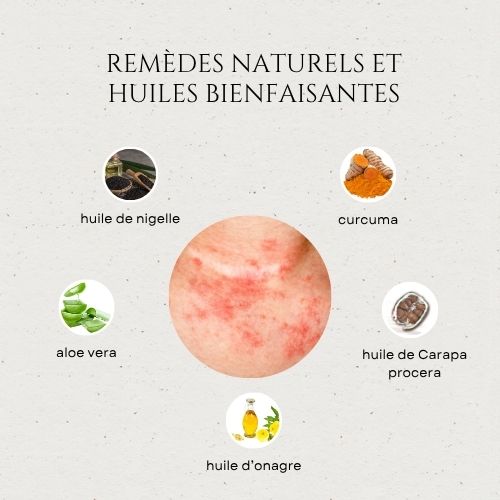 remèdes naturels ayant des bienfaits pour calmer l'eczéma