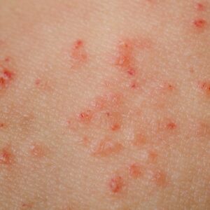 eczema corps depression