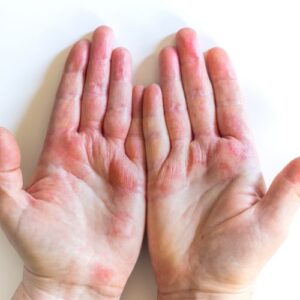 eczema mains depression
