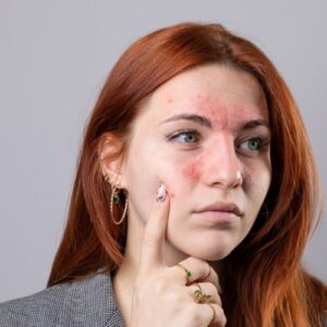eczema visage depression