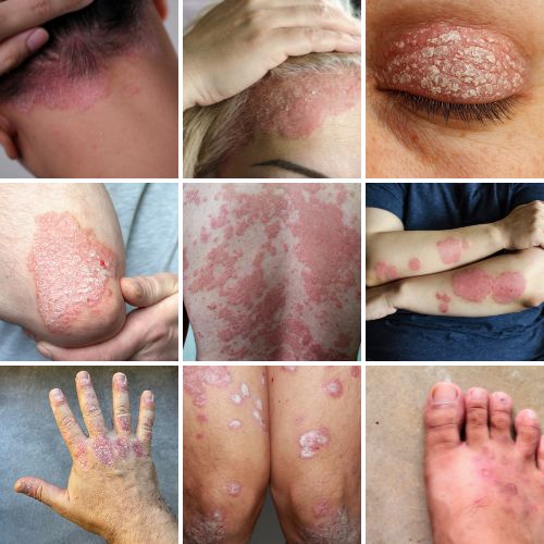 psoriasis vision corps visage parties