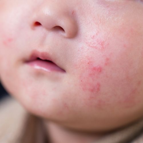 eczéma enfants définition, causes, études et conseils