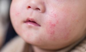 eczéma enfant causes symptômes et 4 conseils clés