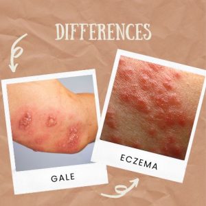 gale vs eczéma enfant