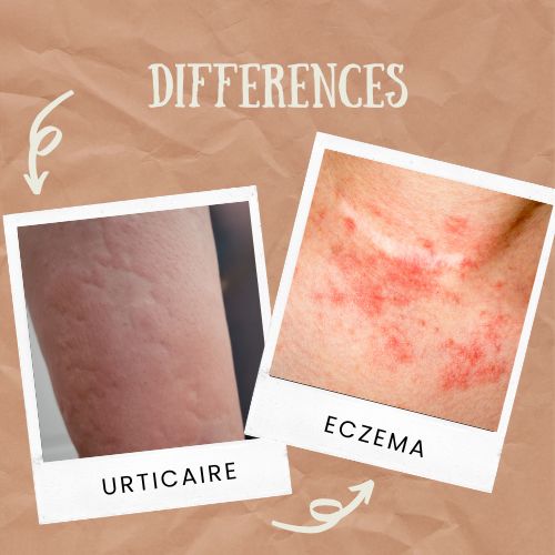 urticaire vs eczéma enfant