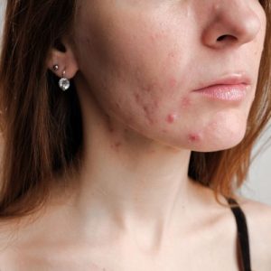 acné hormonale menton visage